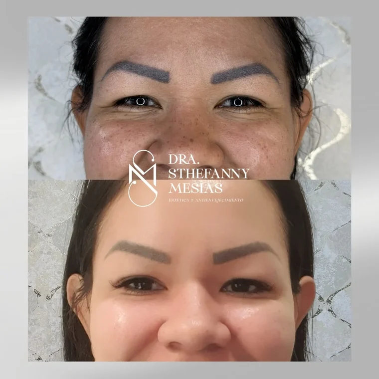 Resultado antes y después de una aplicación de toxina botulínica realizada por la Dra. Sthefanny Mesías en Cali, caso 5