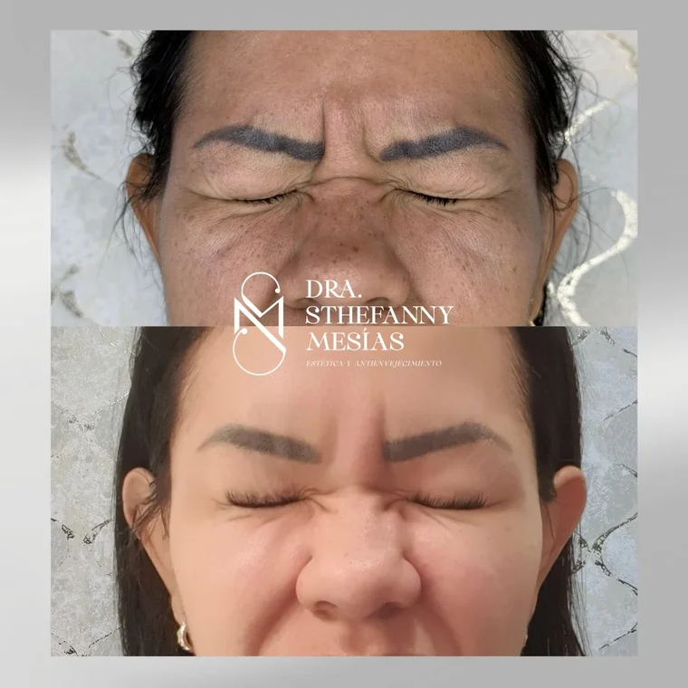 Resultado antes y después de una aplicación de toxina botulínica realizada por la Dra. Sthefanny Mesías en Cali, caso 6