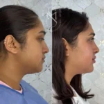Definición mandibular y firmeza facial sin cirugía realizada en Cali por la Dra. Sthefanny Mesias
