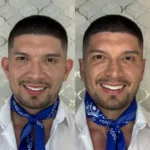 Otoplastia en Cali con la Dra. Sthefanny Mesias: cirugía estética que corrige y armoniza las orejas.