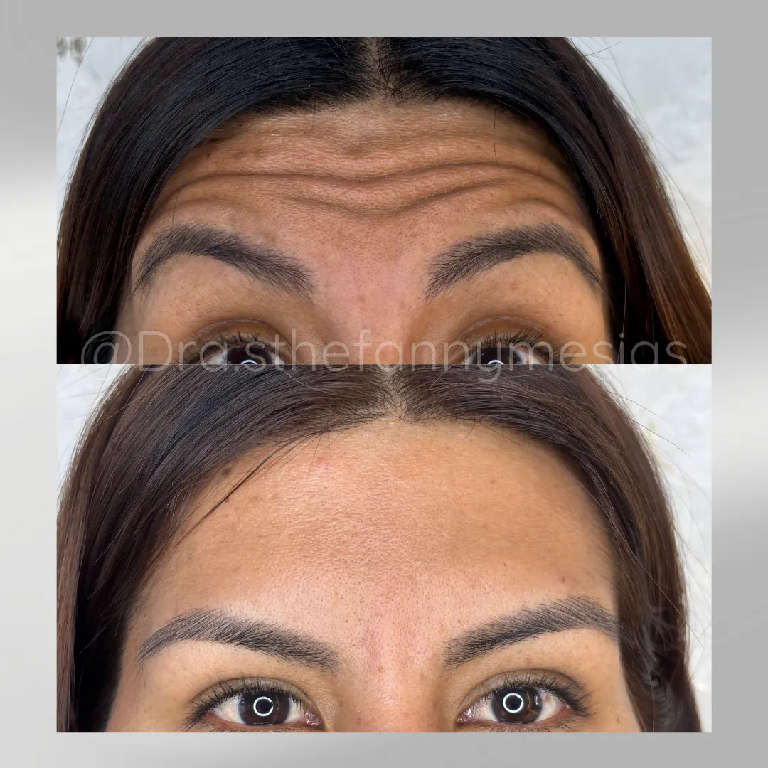 Resultados visibles antes y después de aplicación de toxina botulínica en Cali para rejuvenecimiento facial