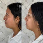 Rinomodelación con ácido hialurónico realizada en Cali, Colombia por la Dra. Sthefanny Mesias, con resultados naturales y seguros