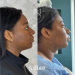 Tratamiento de endolifting facial realizado en Cali por la Dra. Sthefanny Mesias para rejuvenecimiento sin cirugía
