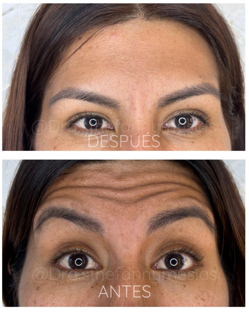 Baby Botox en Cali – Prevención y Naturalidad