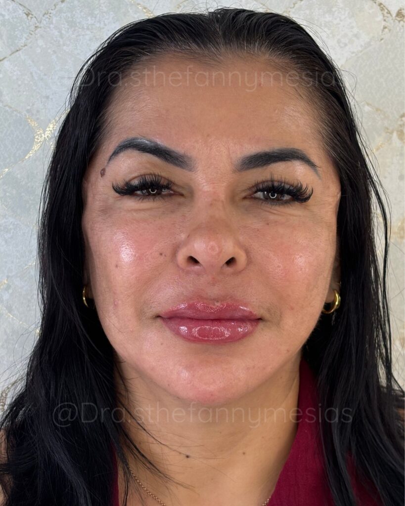 Limpieza Facial Médica: Por qué el SkinCare de casa no es suficiente.