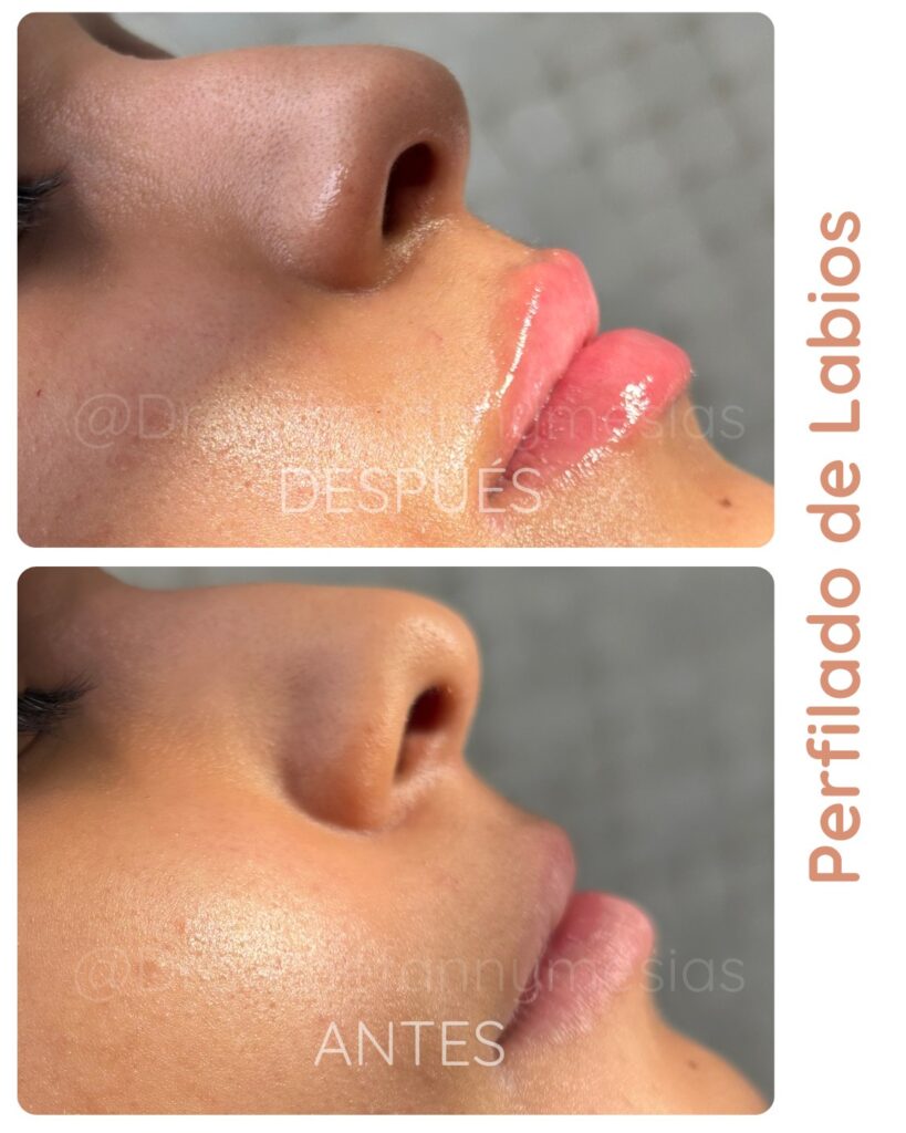 Perfilado de Labios – ¿Natural o Voluminoso?