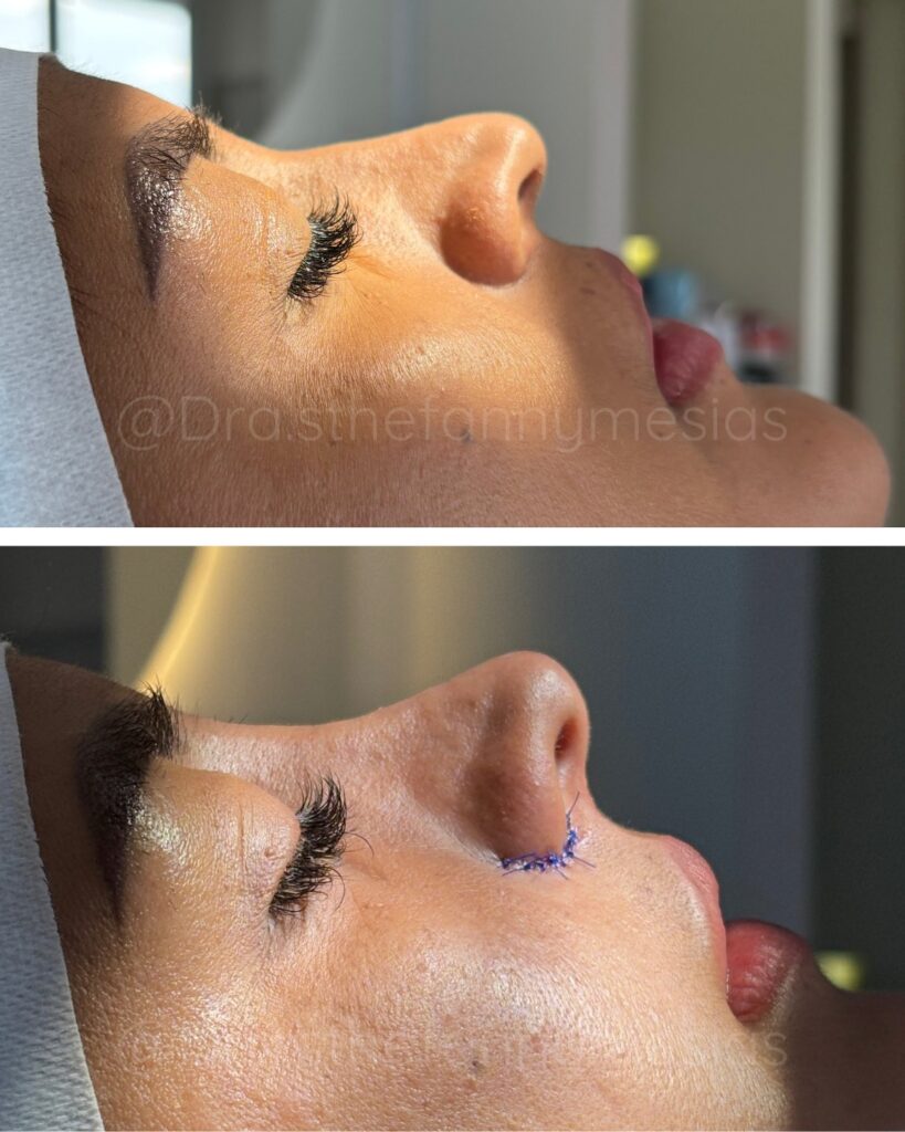 Nariz perfecta sin cirugía: El poder de la Rinomodelación